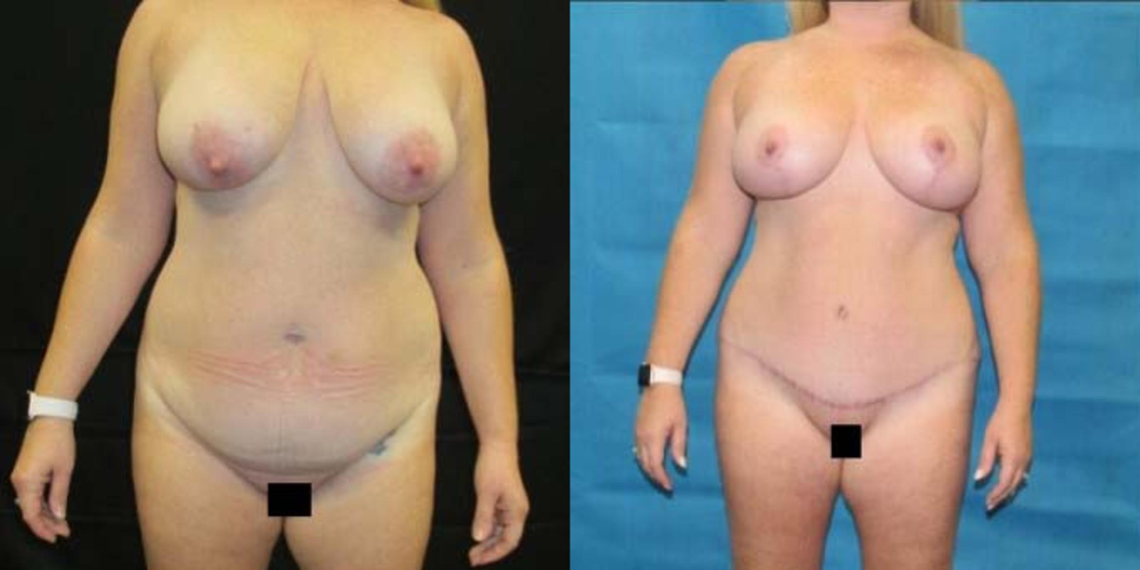 Before & After Breast Lift Case 43 View 1 View in Savannah, GA
