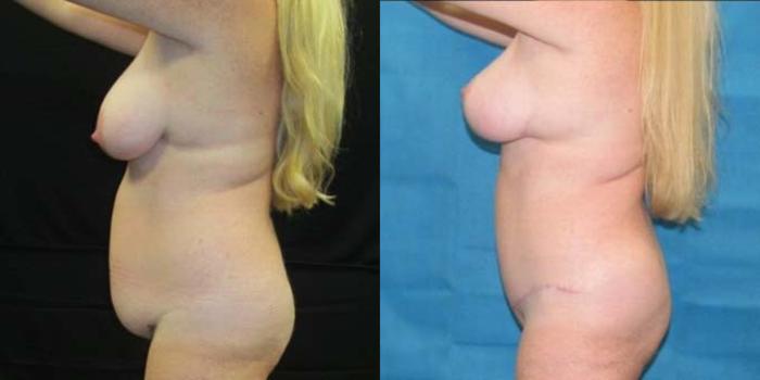 Before & After Breast Lift Case 43 View 2 View in Savannah, GA