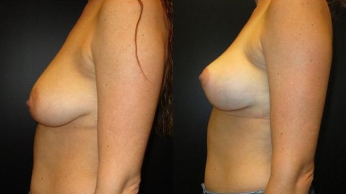 Before & After Breast Lift Case 45 View 2 View in Savannah, GA