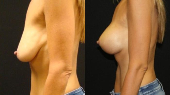 Before & After Breast Lift Case 46 View 2 View in Savannah, GA