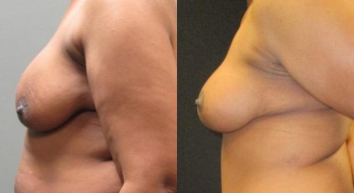 Before & After Breast Lift Case 47 View 2 View in Savannah, GA