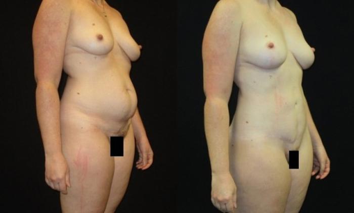 Before & After Breast Lift Case 48 View 2 View in Savannah, GA