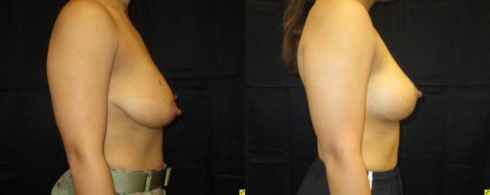 Before & After Breast Lift Case 50 View 2 View in Savannah, GA