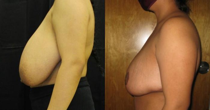 Before & After Breast Reduction Case 51 View 2 View in Savannah, GA