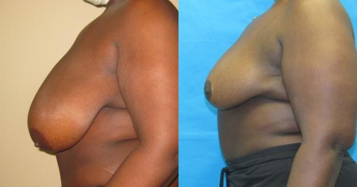 Before & After Breast Reduction Case 52 View 2 View in Savannah, GA