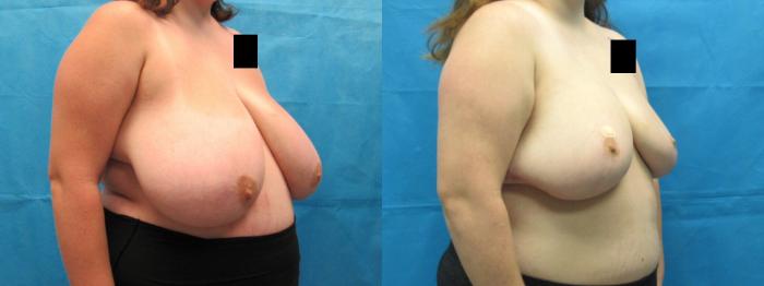 Before & After Breast Reduction Case 53 View 2 View in Savannah, GA