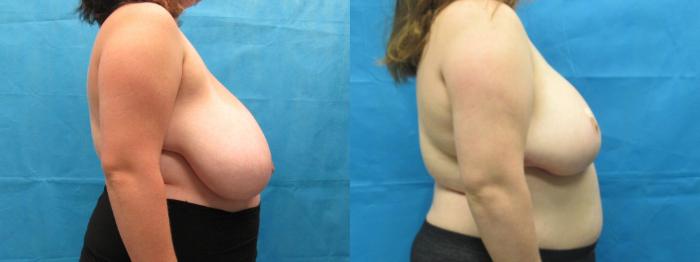 Before & After Breast Reduction Case 53 View 3 View in Savannah, GA