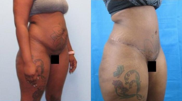 Before & After Liposuction Case 149 View 2 View in Savannah, GA