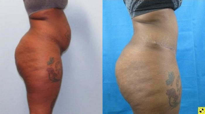 Before & After Liposuction Case 149 View 3 View in Savannah, GA