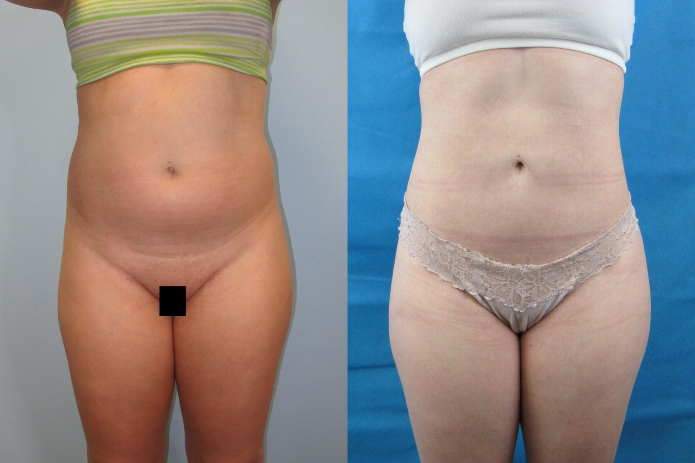 Before & After Liposuction Case 152 View 1 View in Savannah, GA