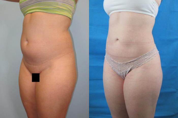 Before & After Liposuction Case 152 View 2 View in Savannah, GA