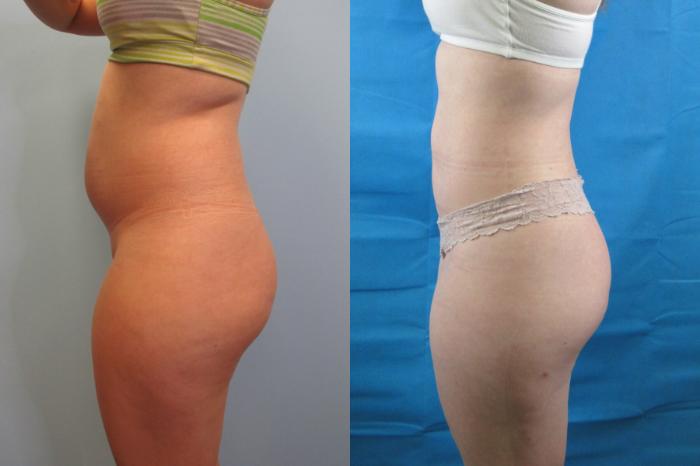 Before & After Liposuction Case 152 View 3 View in Savannah, GA