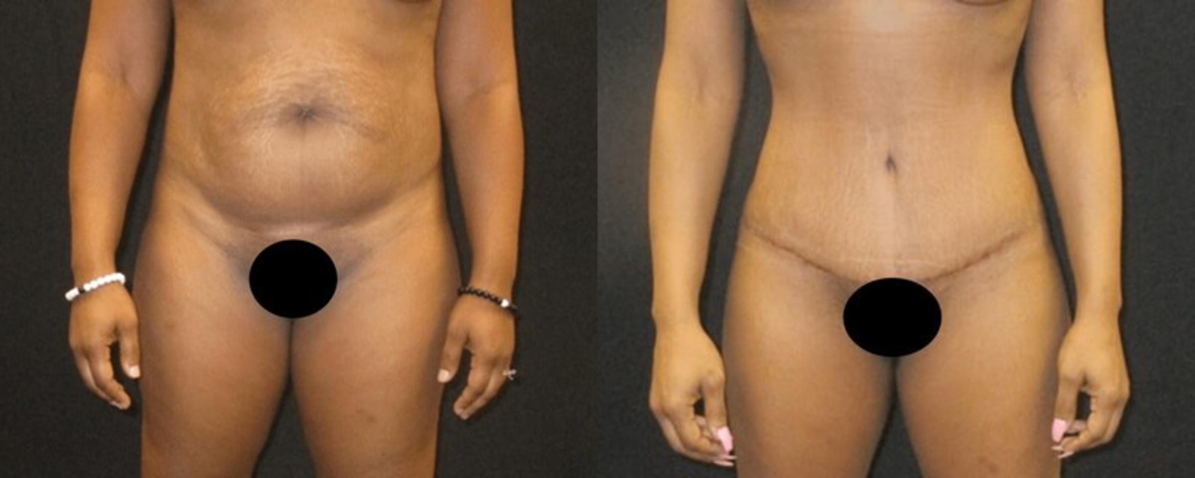 Before & After Liposuction Case 153 View 1 View in Savannah, GA
