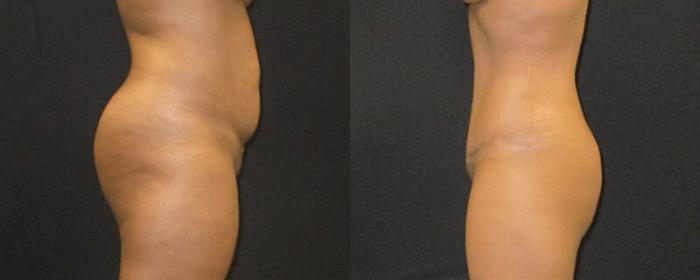Before & After Liposuction Case 153 View 2 View in Savannah, GA