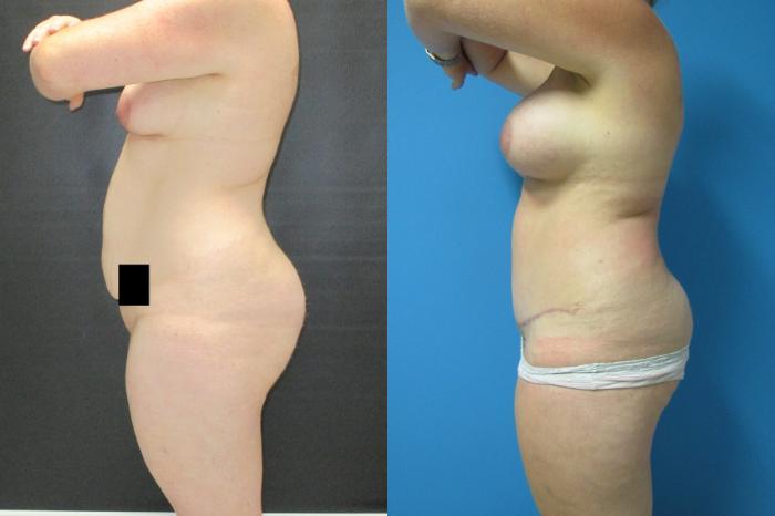 Before & After Mommy Makeover Case 102 View 3 View in Savannah, GA