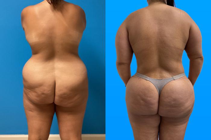 Before & After Mommy Makeover Case 158 Back View in Savannah, GA