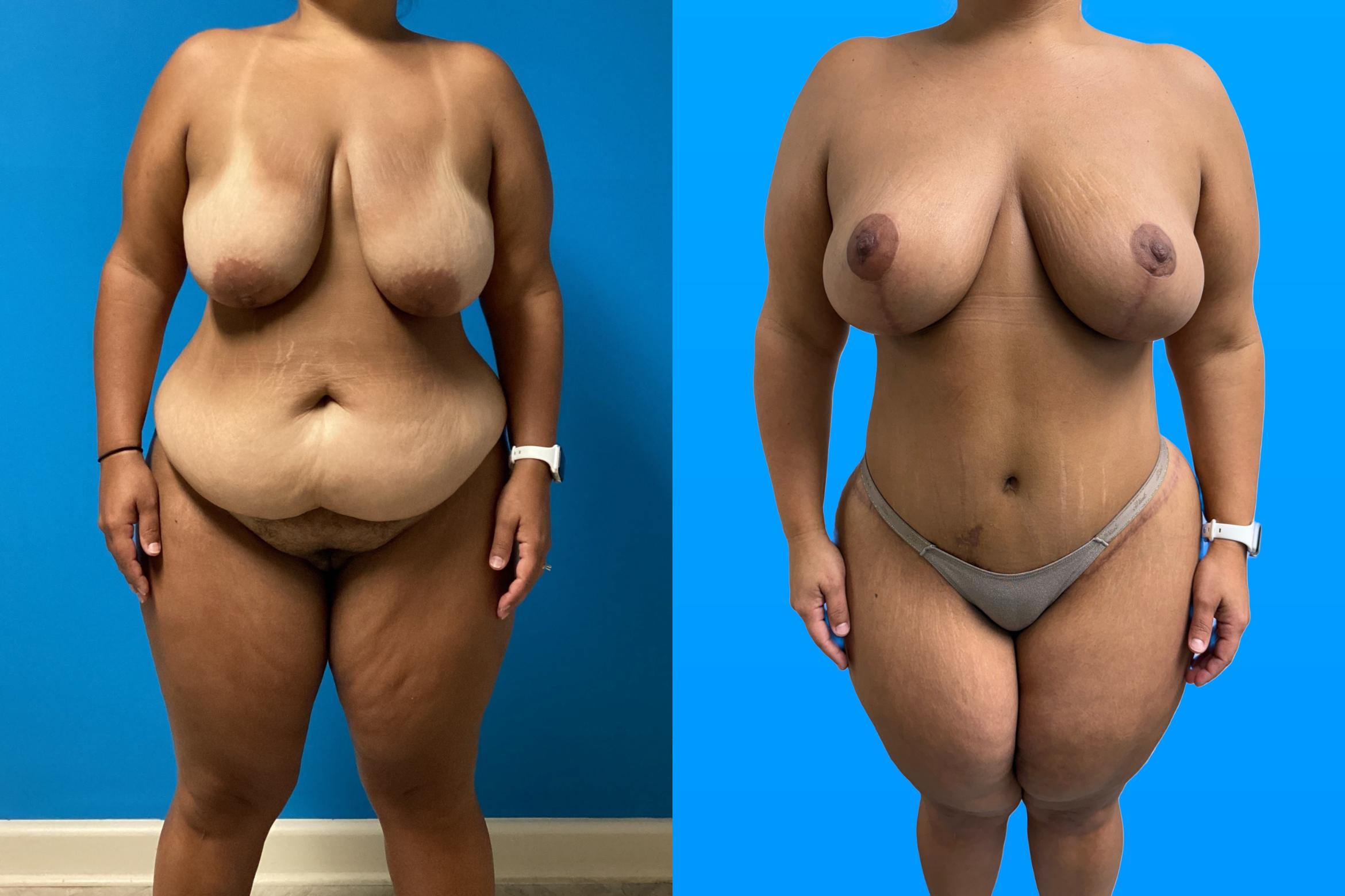 Before & After Mommy Makeover Case 158 Front View in Savannah, GA