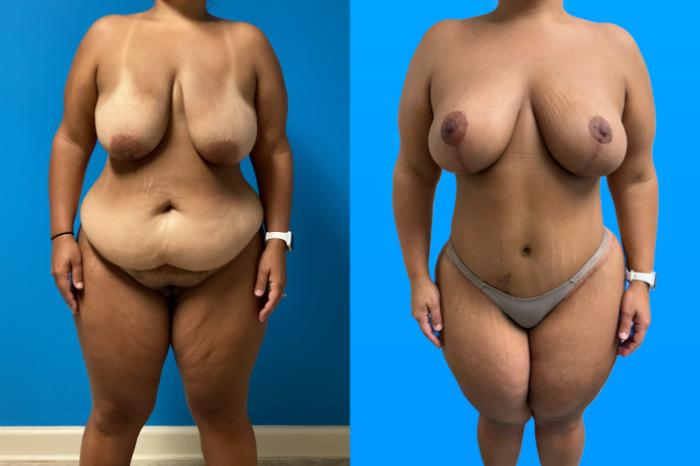 Before & After Mommy Makeover Case 158 Front View in Savannah, GA