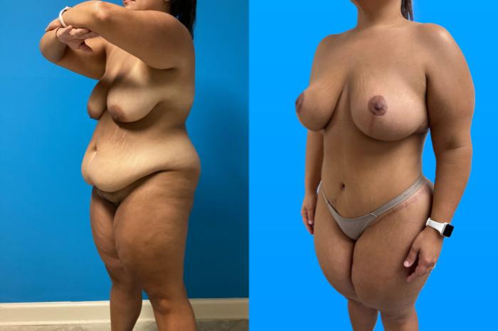 Before & After Mommy Makeover Case 158 Left Side View in Savannah, GA