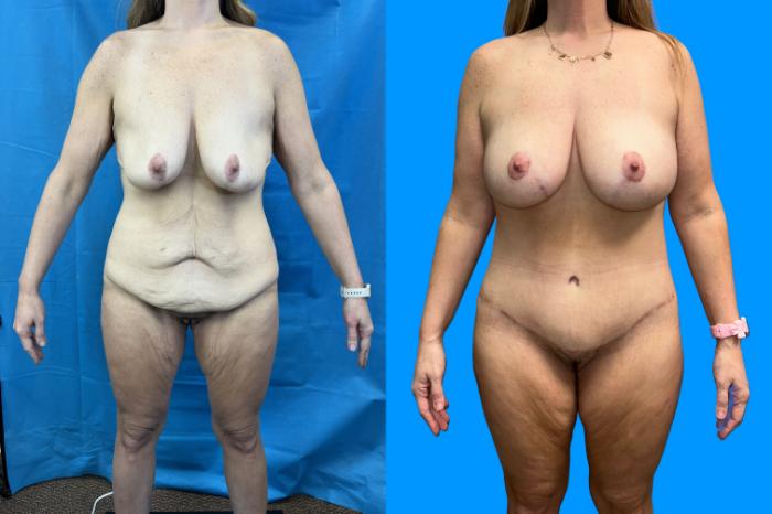 Before & After Breast Augmentation Case 159 Front View in Savannah, GA