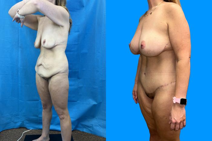 Before & After Mommy Makeover Case 159 Left Oblique View in Savannah, GA