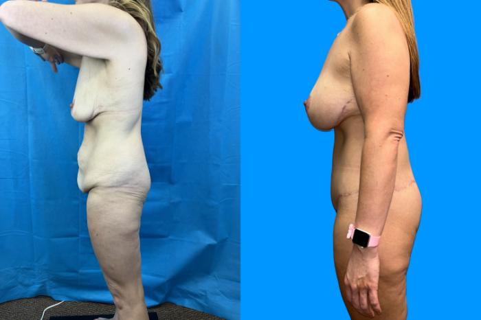 Before & After Mommy Makeover Case 159 Left Side View in Savannah, GA