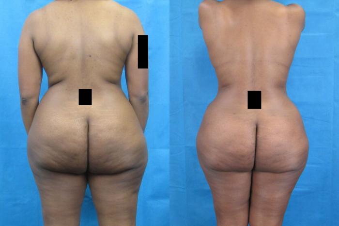 Before & After Mommy Makeover Case 33 View 4 View in Savannah, GA