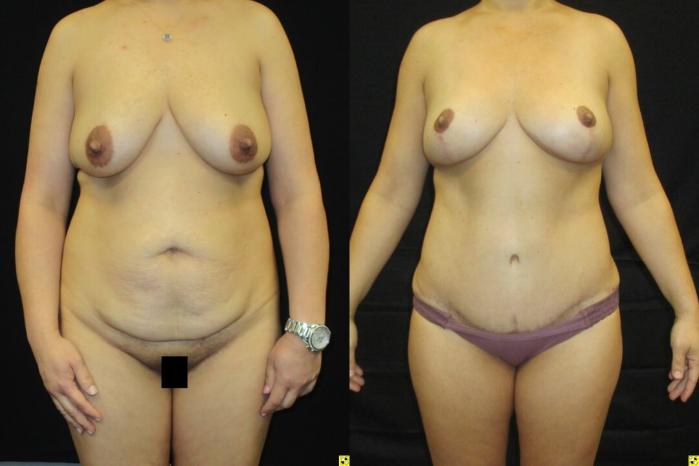 Before & After Mommy Makeover Case 39 View 1 View in Savannah, GA