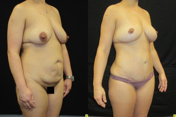 Before & After Mommy Makeover Case 39 View 2 View in Savannah, GA