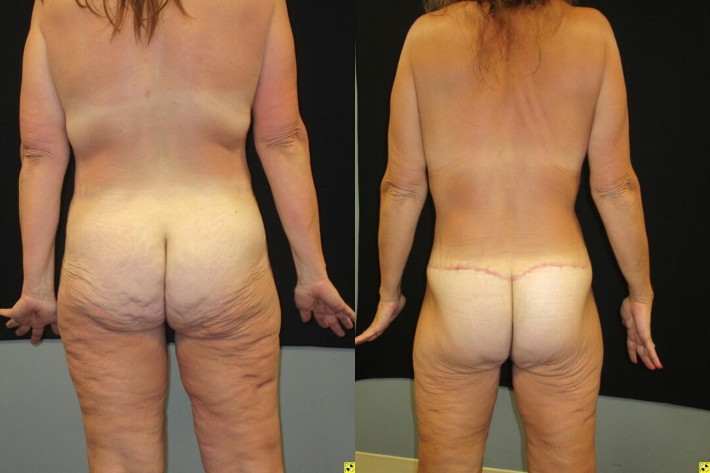 Before & After Mommy Makeover Case 58 View 2 View in Savannah, GA