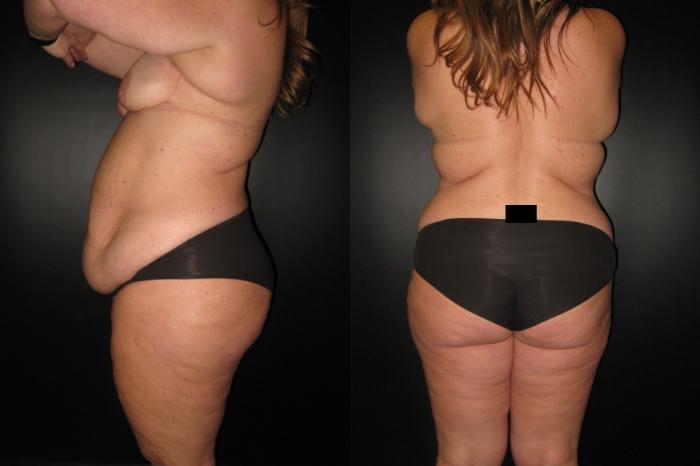 Before & After Mommy Makeover Case 62 View 3 View in Savannah, GA