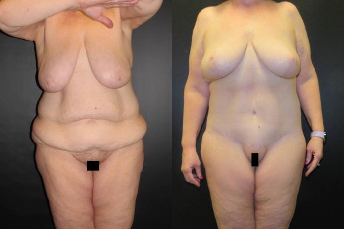 Before & After Mommy Makeover Case 66 View 1 View in Savannah, GA