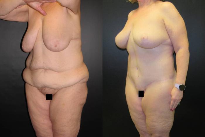 Before & After Mommy Makeover Case 66 View 2 View in Savannah, GA