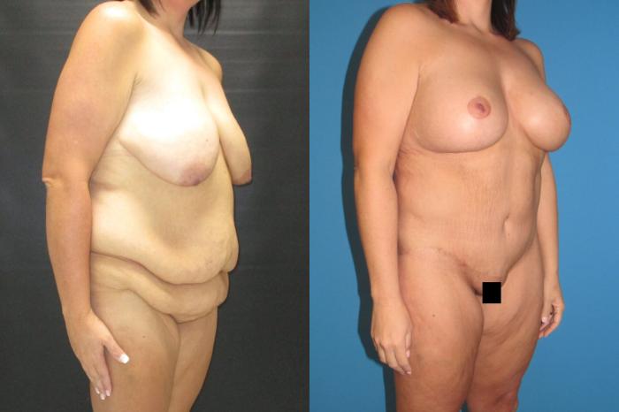 Before & After Mommy Makeover Case 68 View 2 View in Savannah, GA