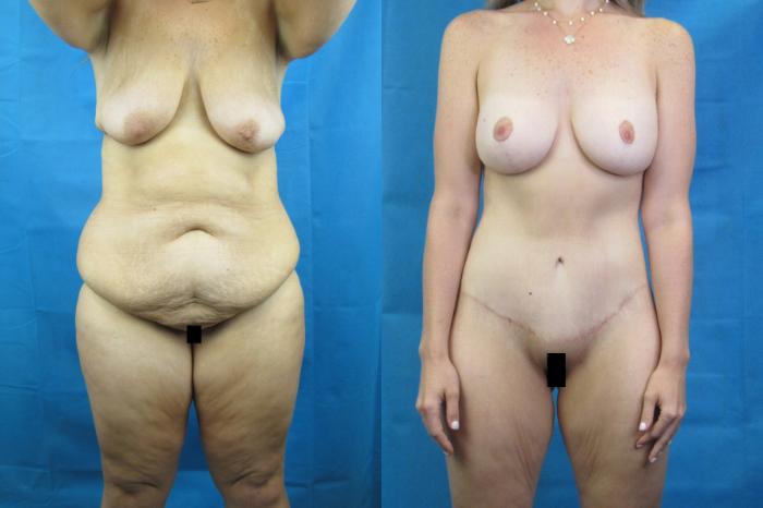 Before & After Mommy Makeover Case 69 View 1 View in Savannah, GA