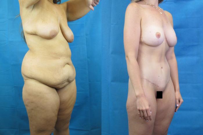 Before & After Mommy Makeover Case 69 View 2 View in Savannah, GA