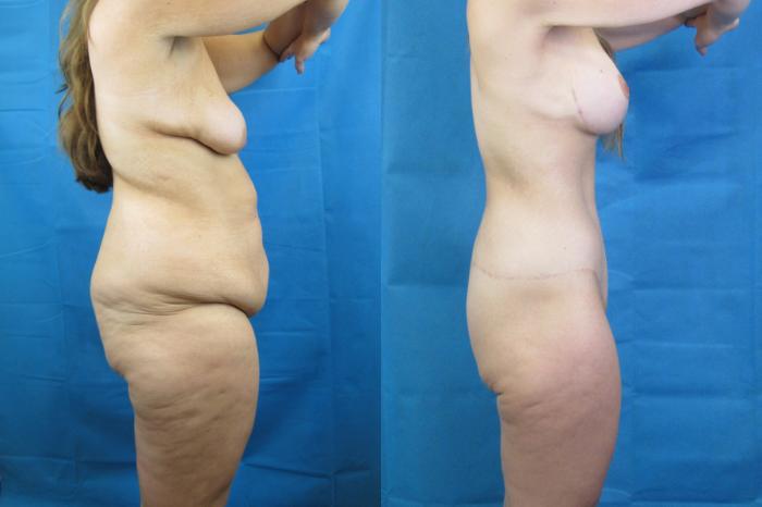 Before & After Mommy Makeover Case 69 View 3 View in Savannah, GA