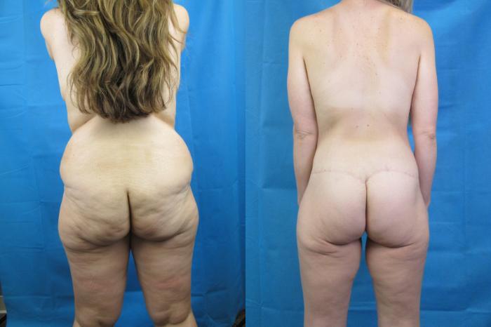 Before & After Mommy Makeover Case 69 View 4 View in Savannah, GA