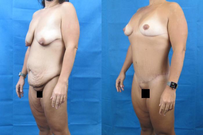 Before & After Mommy Makeover Case 70 View 2 View in Savannah, GA
