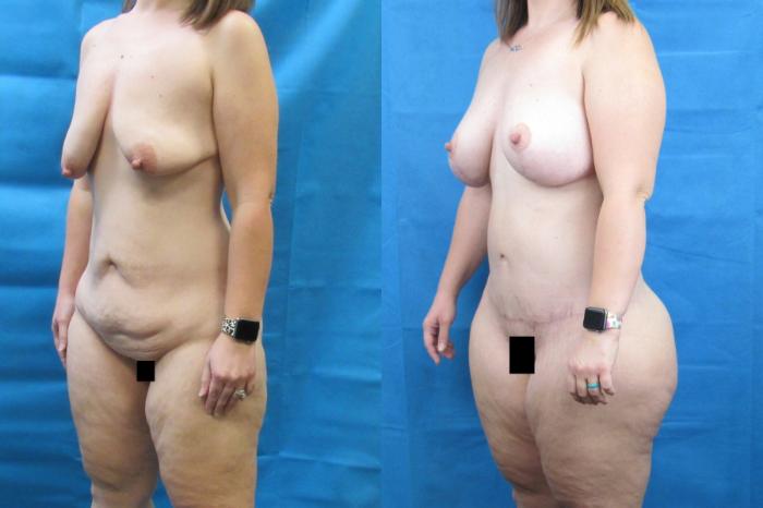 Before & After Mommy Makeover Case 73 View 2 View in Savannah, GA