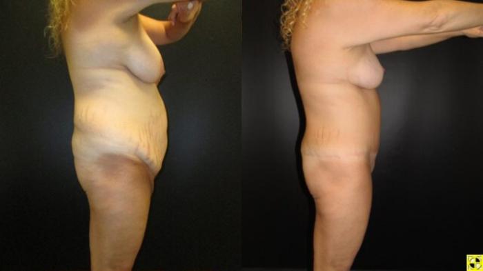 Before & After Mommy Makeover Case 80 View 3 View in Savannah, GA