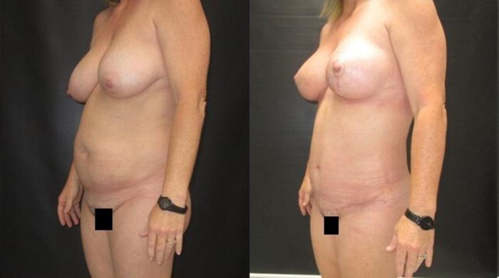 Before & After Mommy Makeover Case 81 View 2 View in Savannah, GA