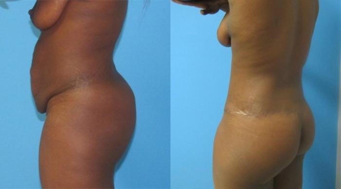 Before & After Mommy Makeover Case 84 View 3 View in Savannah, GA