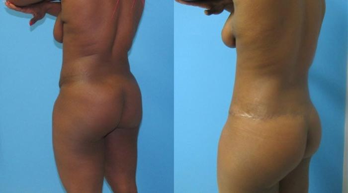 Before & After Mommy Makeover Case 84 View 7 View in Savannah, GA