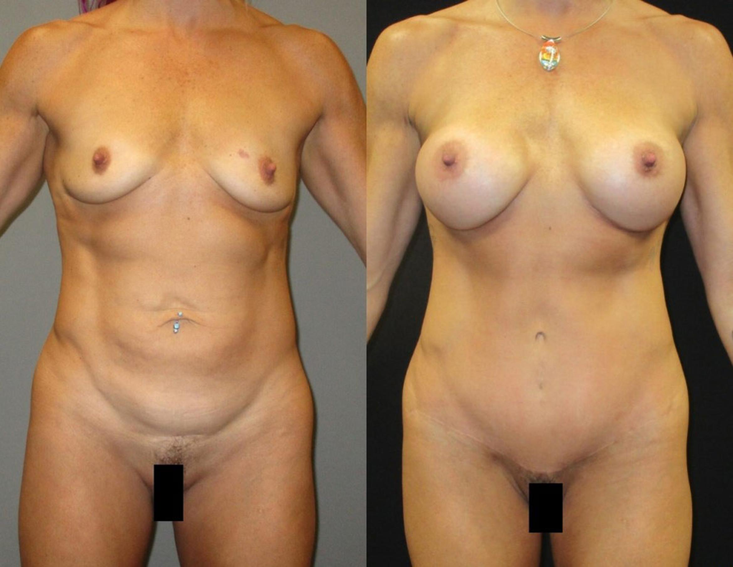 Before & After Mommy Makeover Case 87 View 1 View in Savannah, GA