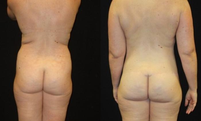 Before & After Mommy Makeover Case 89 View 2 View in Savannah, GA