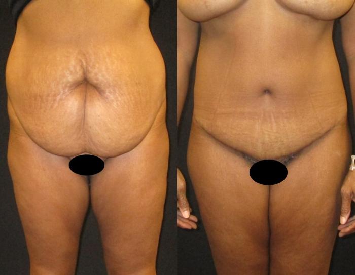 Before & After Mommy Makeover Case 90 View 1 View in Savannah, GA