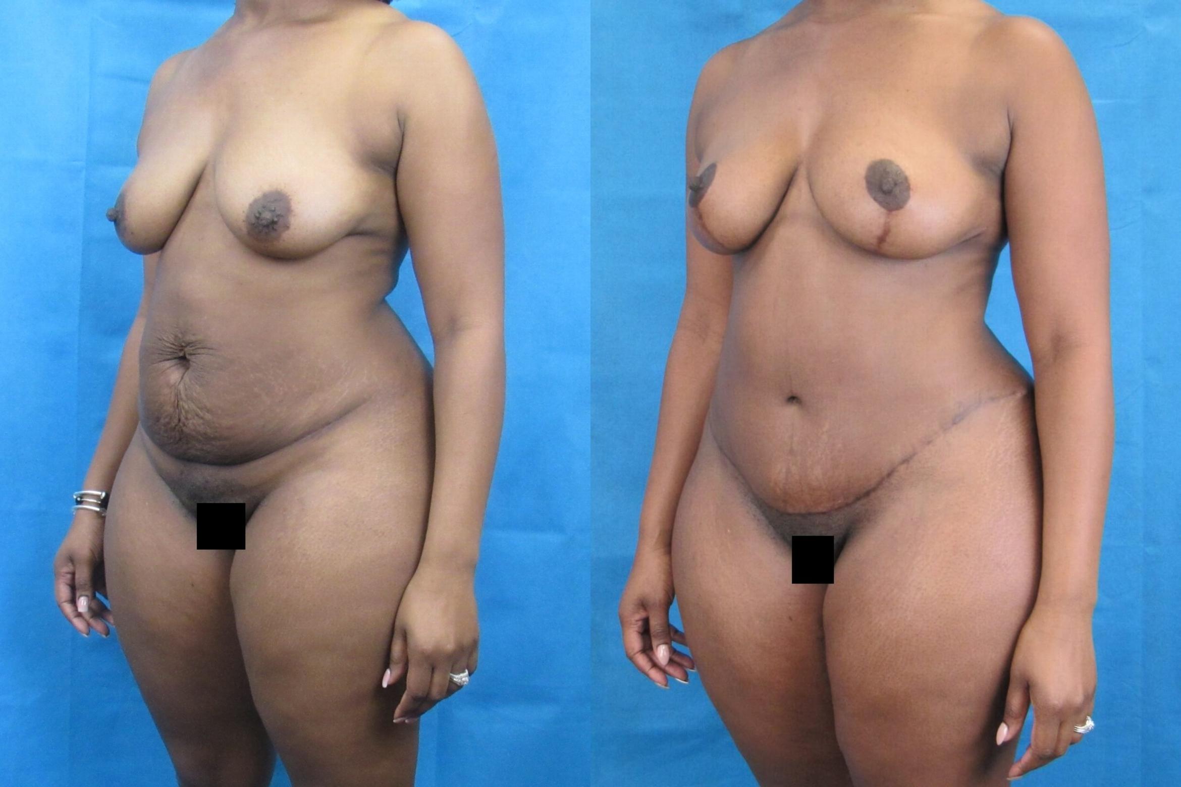 Before & After Mommy Makeover Case 92 View 2 View in Savannah, GA