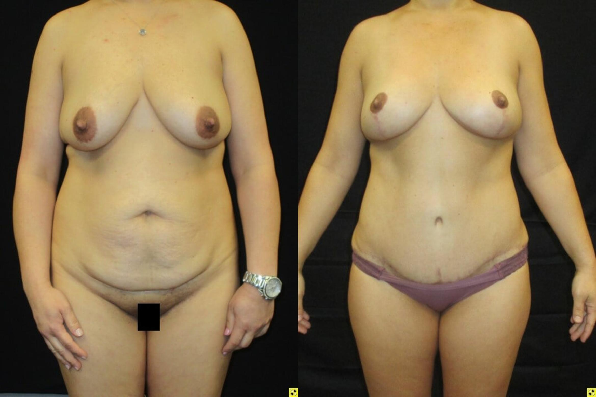 Before & After Mommy Makeover Case 96 View 1 View in Savannah, GA