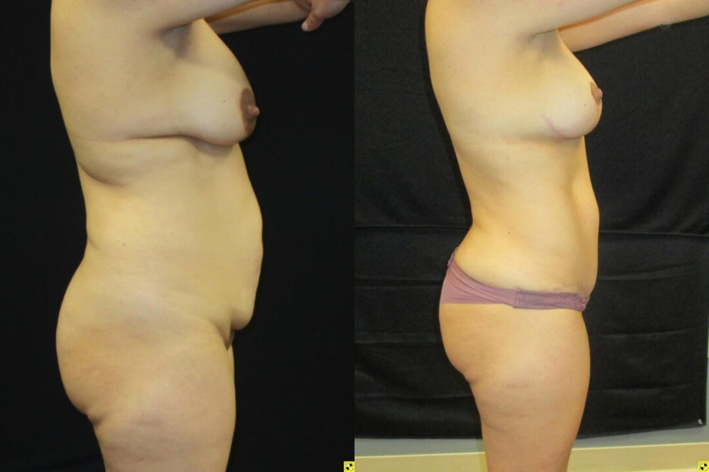 Before & After Mommy Makeover Case 96 View 3 View in Savannah, GA
